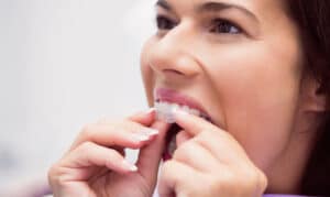 Invisalign