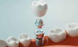Dental Implants In Oak Park IL, One Fine Smile