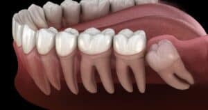 Wisdom Tooth Extraction In Oak Park