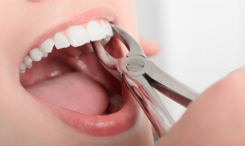 Emergency Tooth Extraction- What to Do and What to Expect