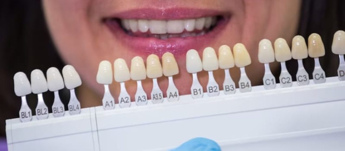 4 Things You Need To Know Before Getting Porcelain Veneers