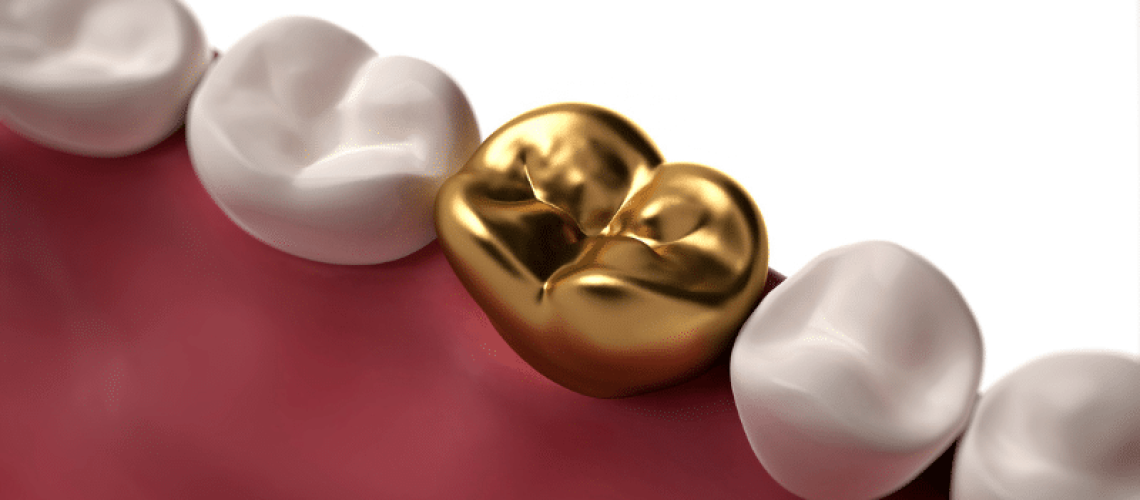 Best Dental Filling For Cavity