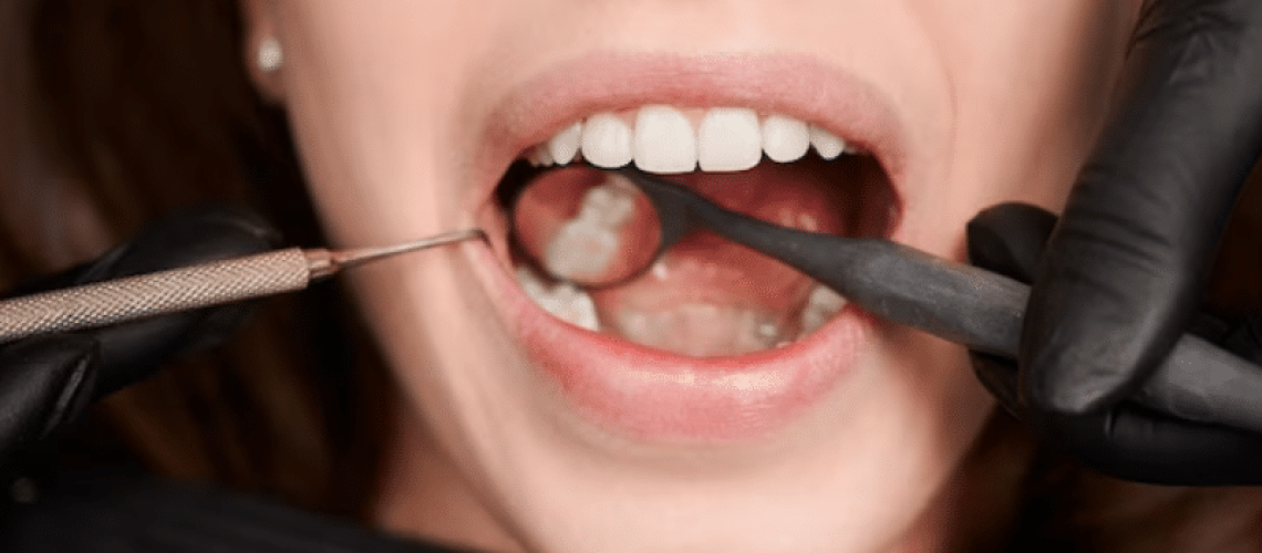 Common Reasons for Tooth Extractions