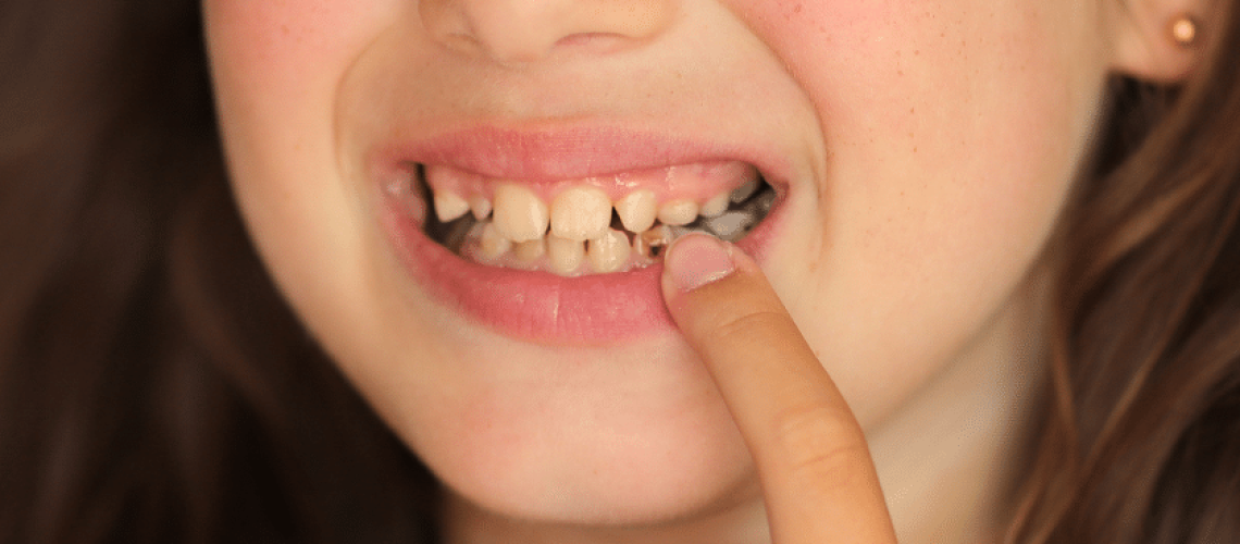 Cracking the Code of Tooth Decay- Prevention and Treatment Strategies