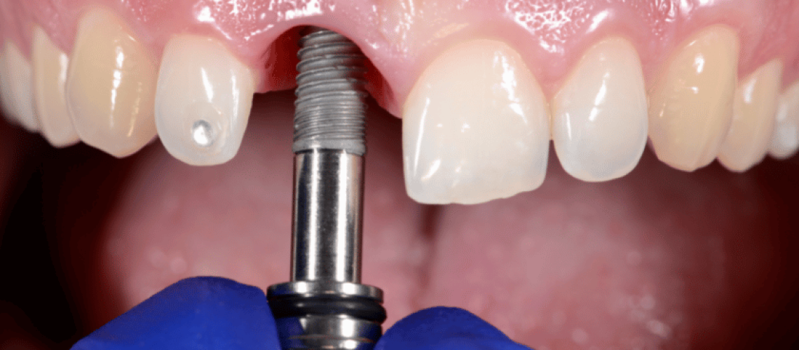 Denture