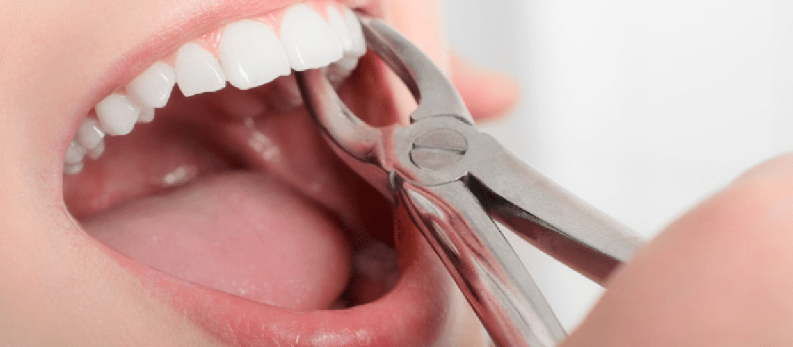 Emergency Tooth Extraction- What to Do and What to Expect