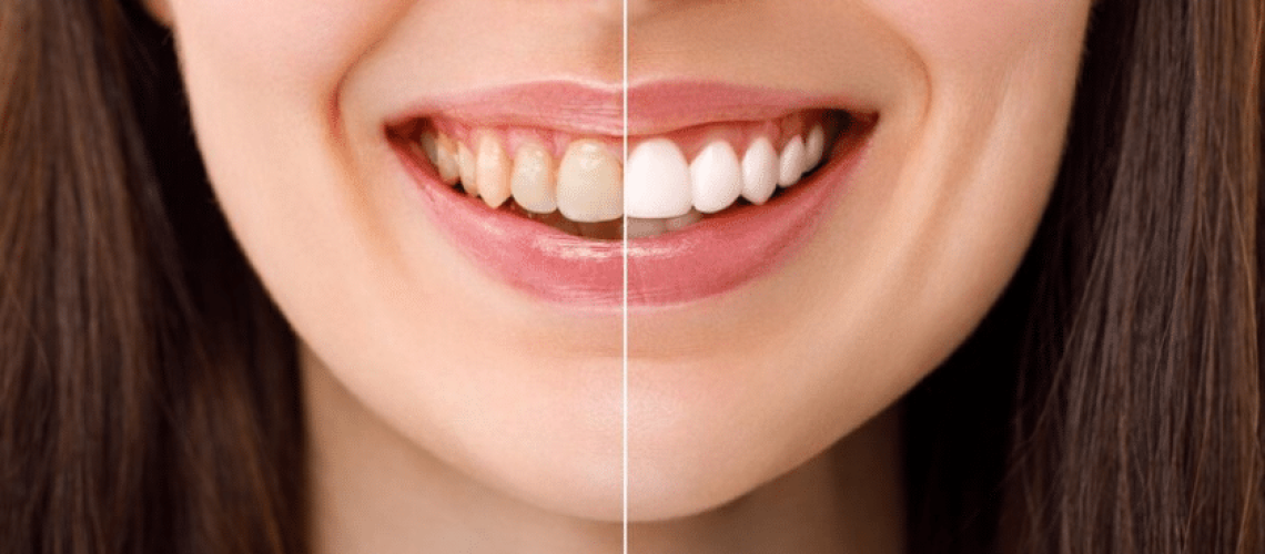 From Coffee Stains to Crystal Clear- How Teeth Whitening Can Reverse Discoloration