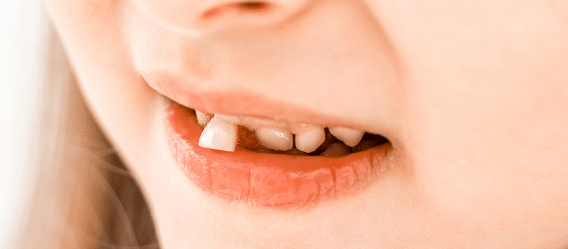 Lost Baby Tooth? A Guide to Saving and Reimplanting Knocked-Out Teeth