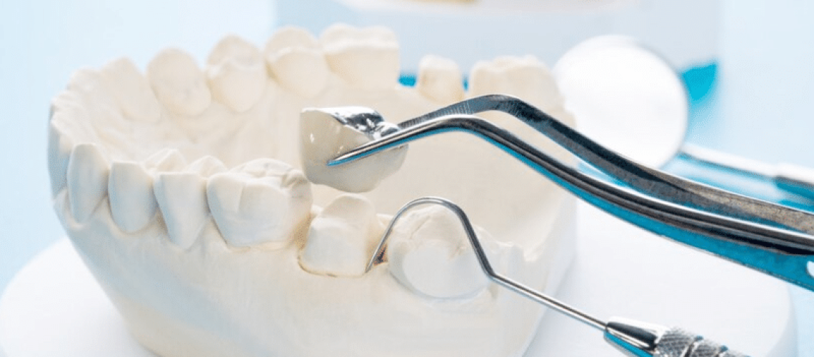 The Aesthetic Benefits of Crown Lengthening Procedures