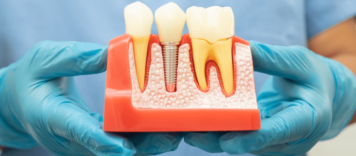 The Power of Dental Implants- Your Ultimate Tooth Replacement Solution