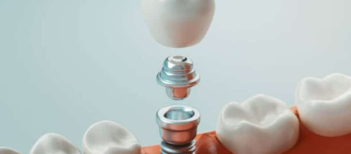 Dental Implants In Oak Park IL, One Fine Smile