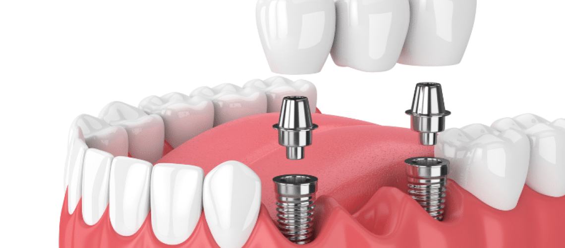 Why Fixed Bridges Matter In Restorative Dentistry