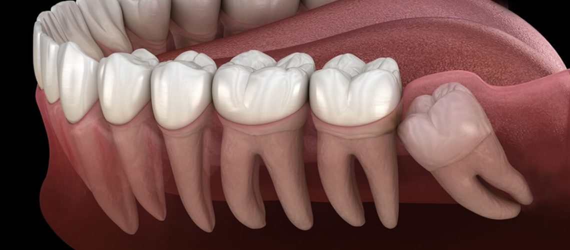 Wisdom Tooth Extraction In Oak Park