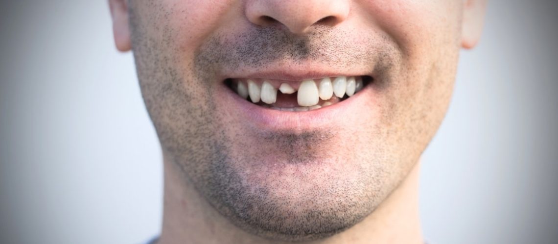emergency dentist for knocked out tooth