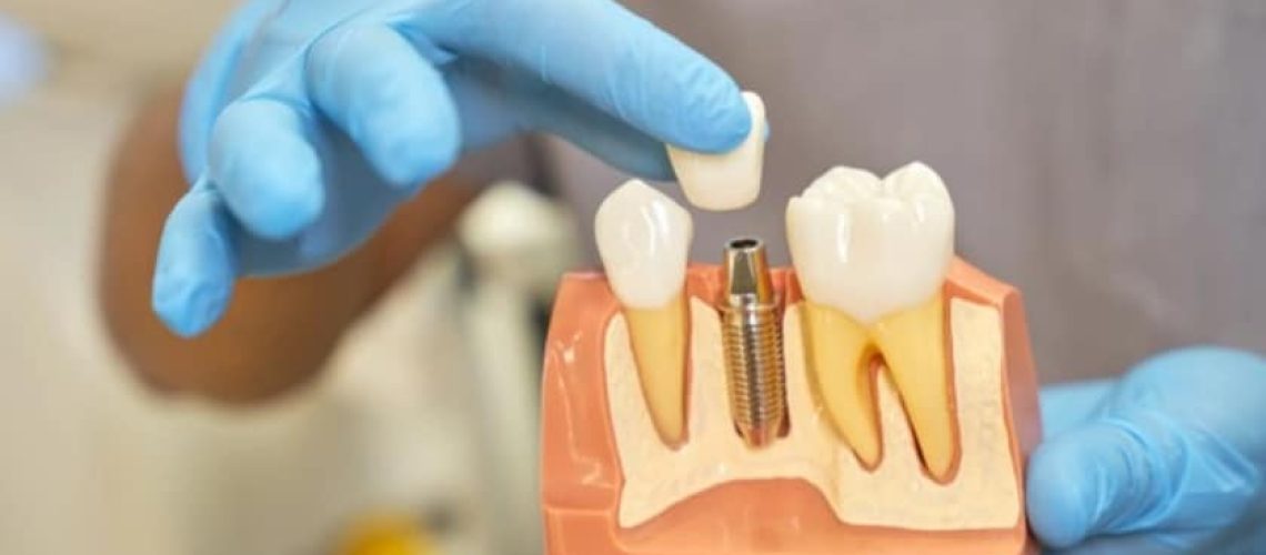 dental implants