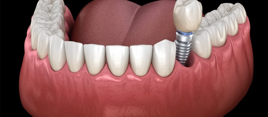 How to Care for Your Dental Implants Tips for Long-Lasting Results