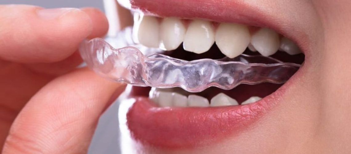 Invisalign in Oak Park - correcting overbites