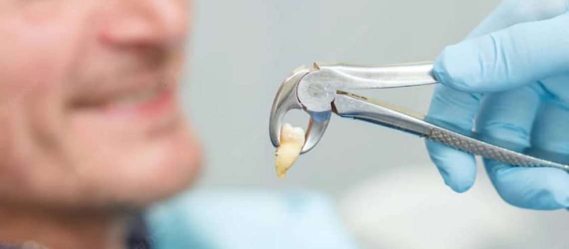 tooth extraction