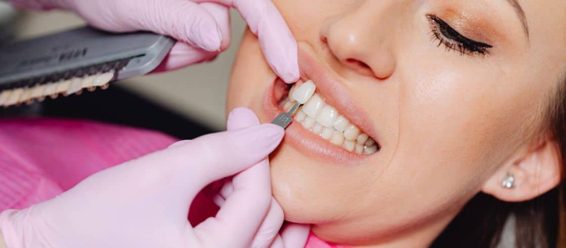 porcelain veneers for valentine's day